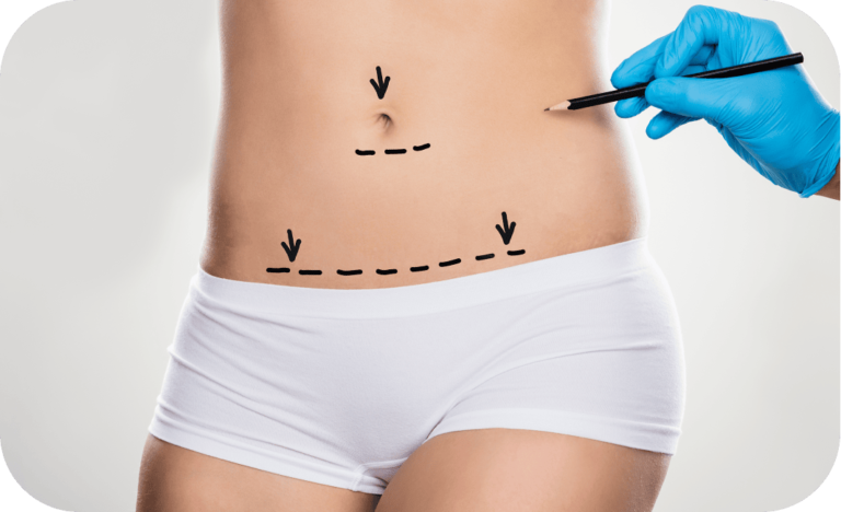 Abdominoplasty / Tummy Tuck - Modern Plastic Surgery Miami