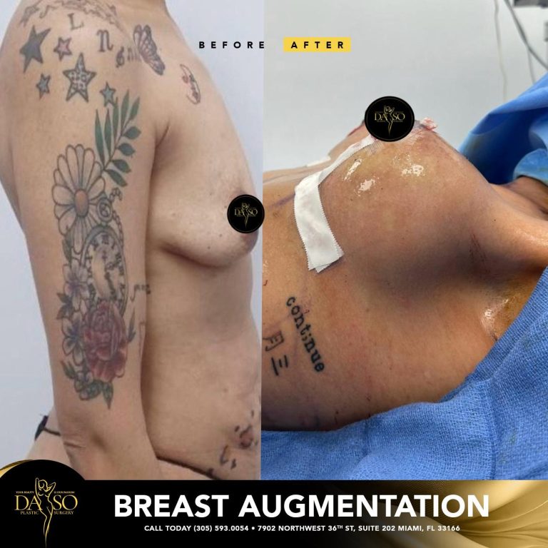 Breast Augmentation Daso Plastic Surgery