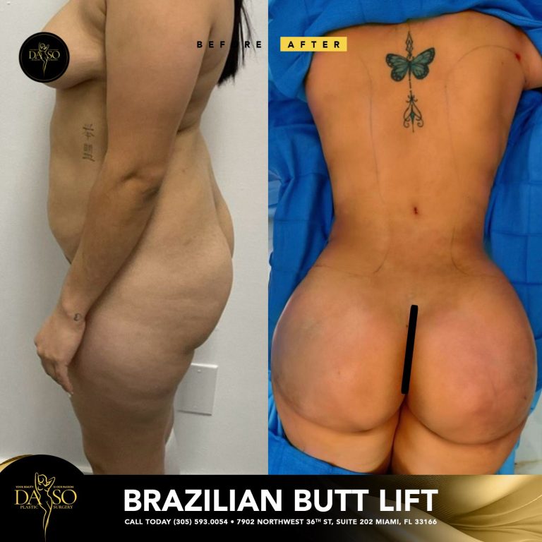 Brazilian But Lift - Daso Plastic Surgery