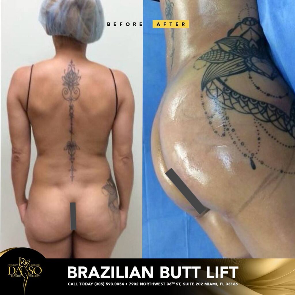 brazilian butt lift