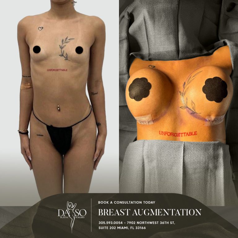 BREAST AUG 1