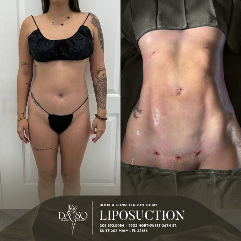LIPO 2
