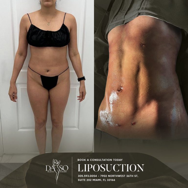 LIPO 5