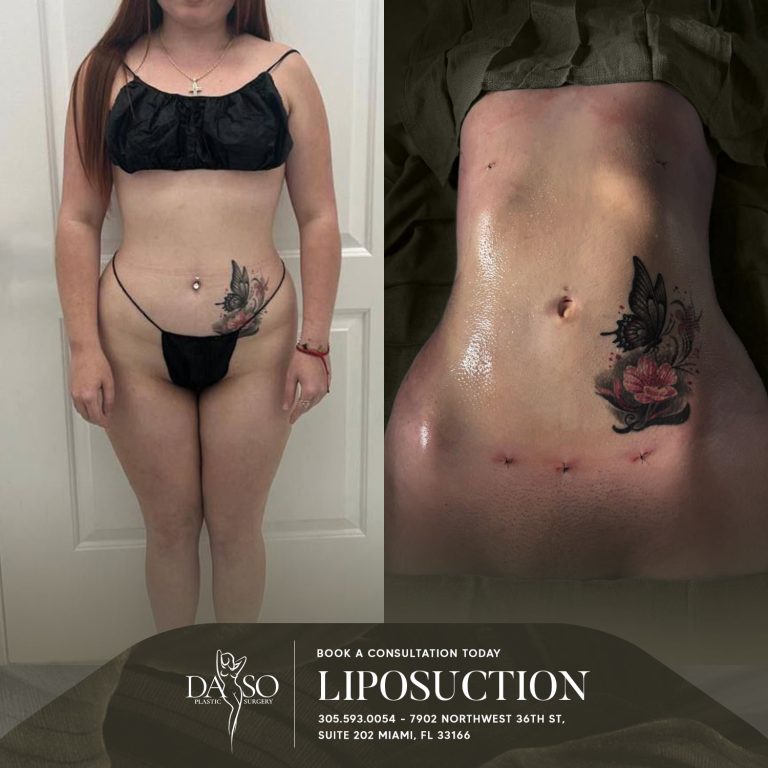 LIPO 6