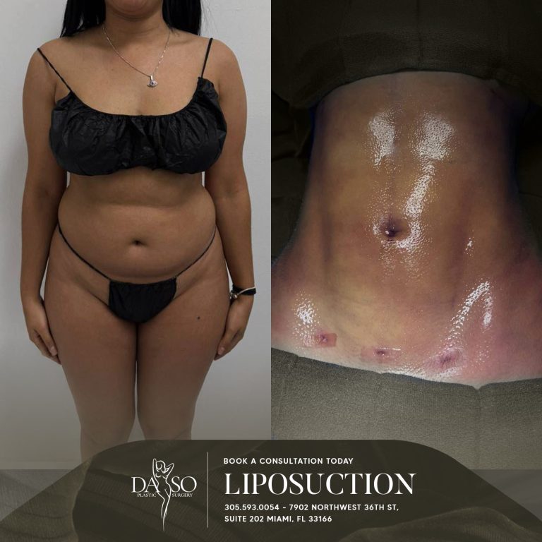 LIPO 7
