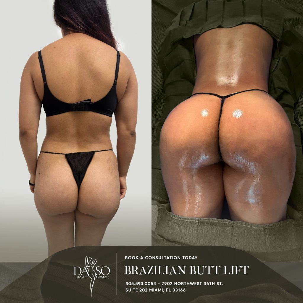 brazilian butt lift