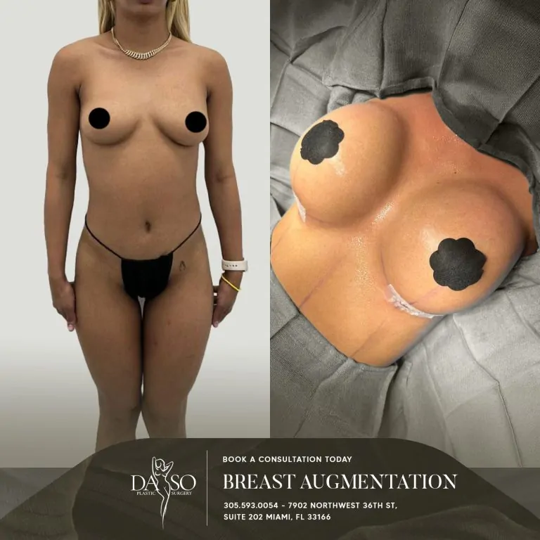 BREAST AUG 2