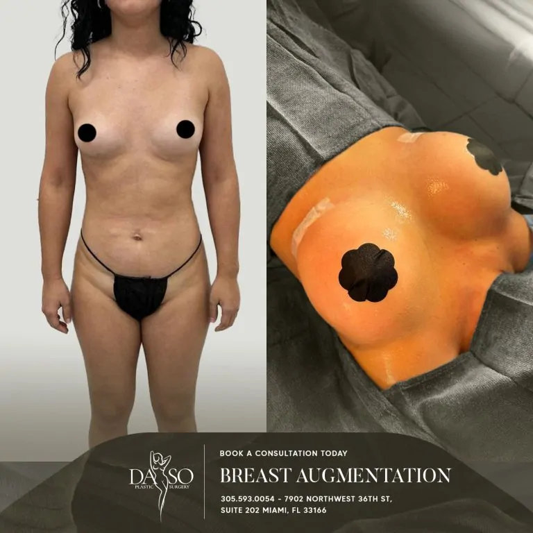 BREAST AUG 5