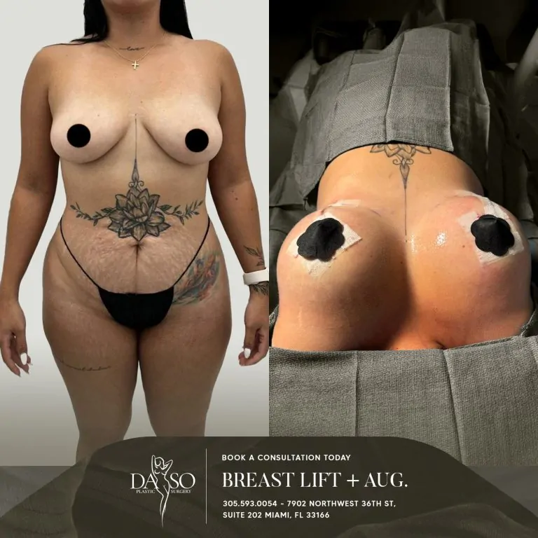 BREAST AUG 6 lift plus aug
