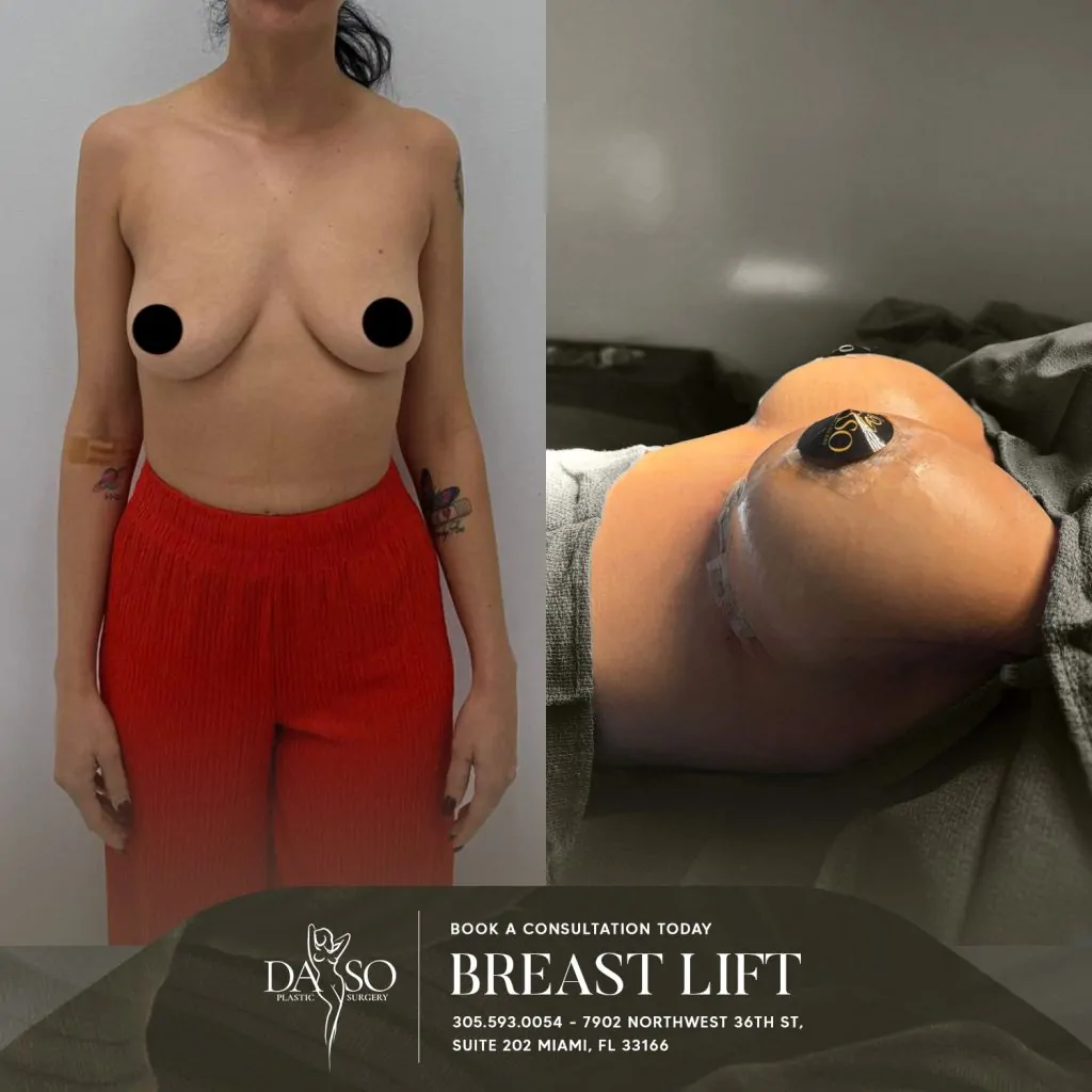 breast surgery
