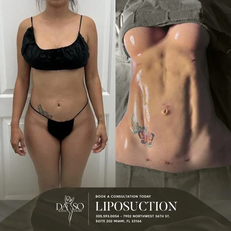LIPO 1