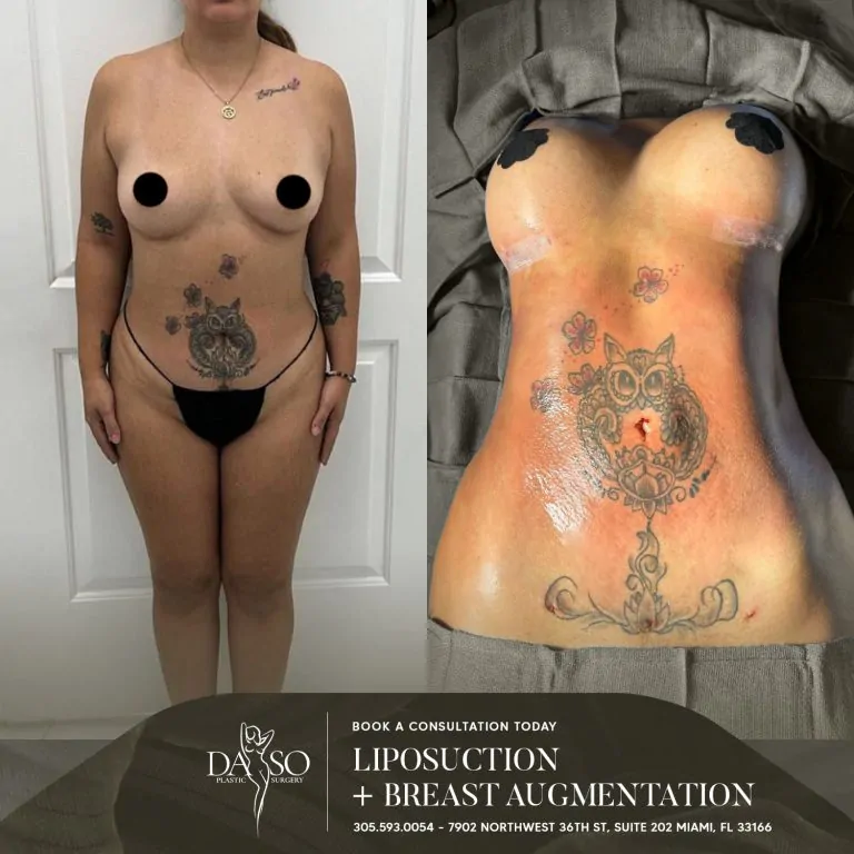 LIPO 4 plus BREAST AUG