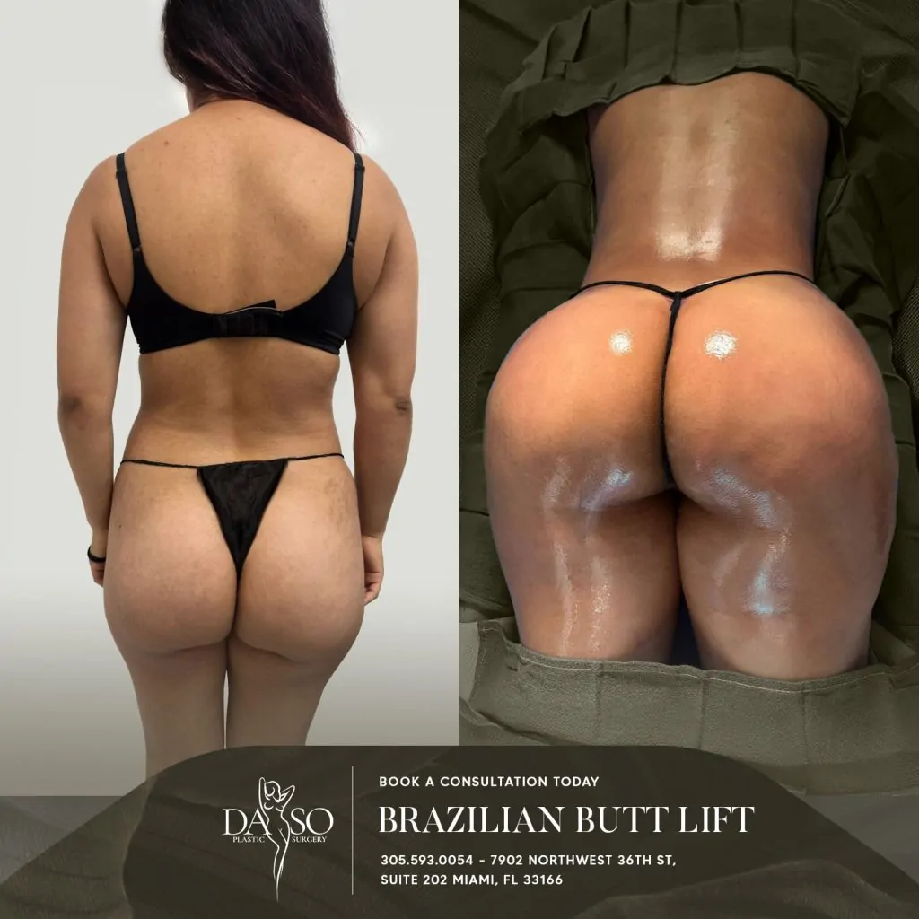 brazilian butt lift